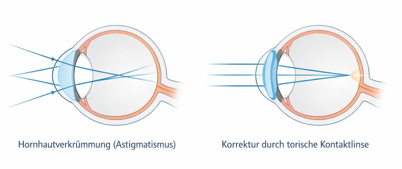 Torische Kontaktlinsen erklärt